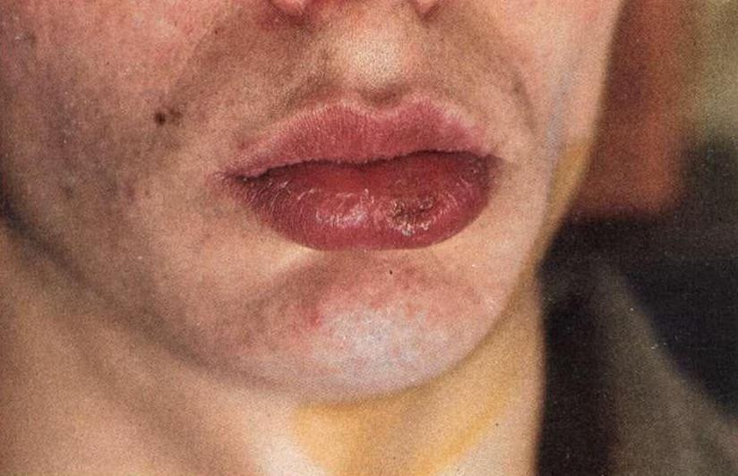  признаки сифилиса на губе 